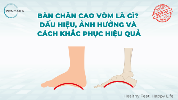 Bàn chân cao vòm là gì? Dấu hiệu, ảnh hưởng và cách khắc phục hiệu quả