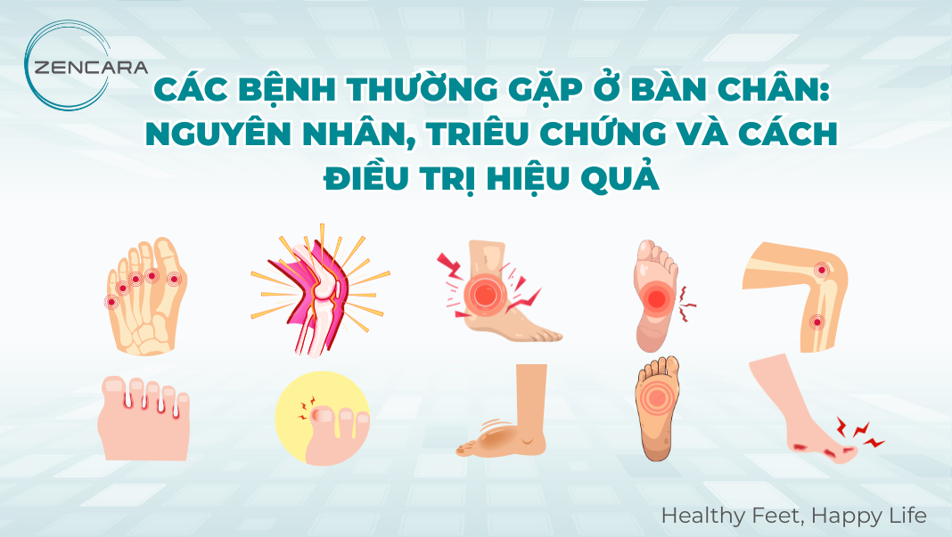 Các bệnh thường gặp ở bàn chân: Nguyên nhân, triêu chứng và cách điều trị hiệu quả