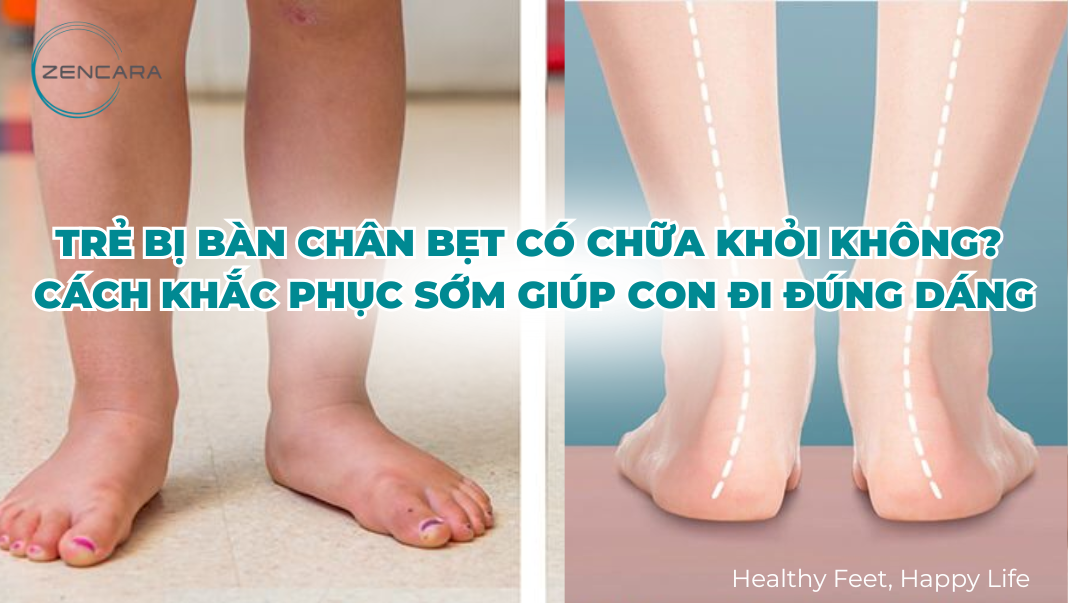 Trẻ bị bàn chân bẹt có chữa khỏi không? Cách khắc phục sớm giúp con đi đúng dáng