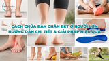 Cách chữa bàn chân bẹt ở người lớn, hướng dẫn chi tiết & giải pháp hiệu quả