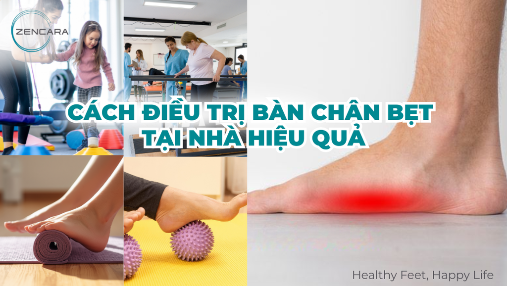 Cách điều trị bàn chân bẹt tại nhà hiệu quả qua các bài tập và mẹo cải thiện dáng vòm chân