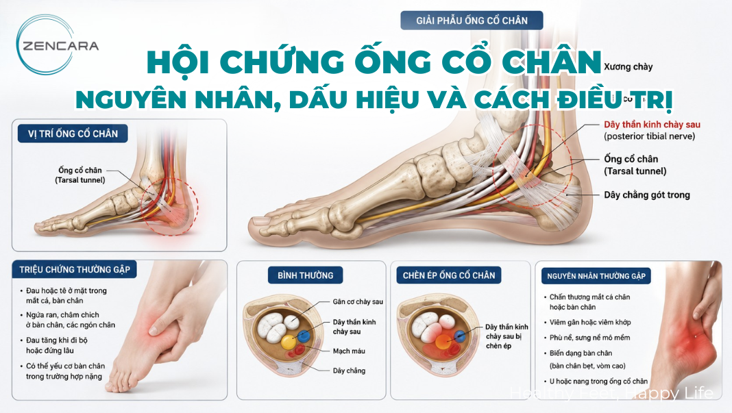 Hội chứng ống cổ chân (Tarsal Tunnel): Nguyên nhân, dấu hiệu và cách điều trị