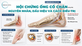 Hội chứng ống cổ chân (Tarsal Tunnel): Nguyên nhân, dấu hiệu và cách điều trị