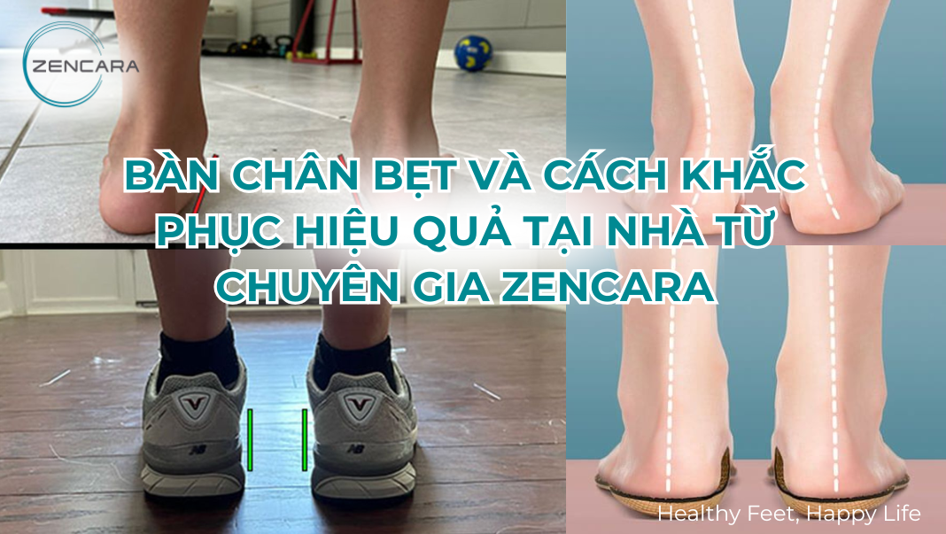 Bàn chân bẹt và cách khắc phục hiệu quả tại nhà từ chuyên gia Zencara
