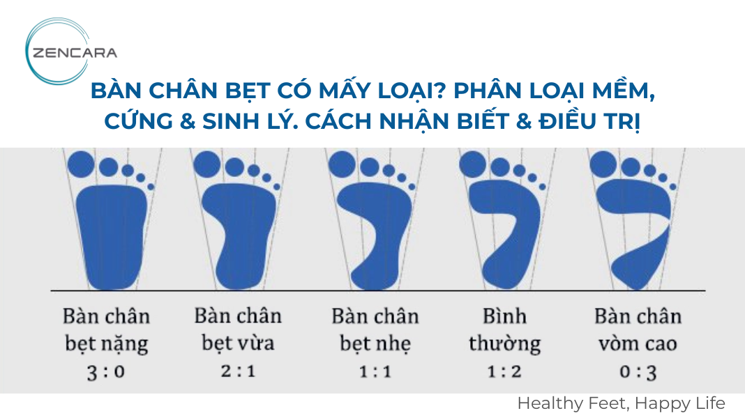 Bàn chân bẹt có mấy loại? Phân loại mềm, cứng & sinh lý. Cách nhận biết & điều trị