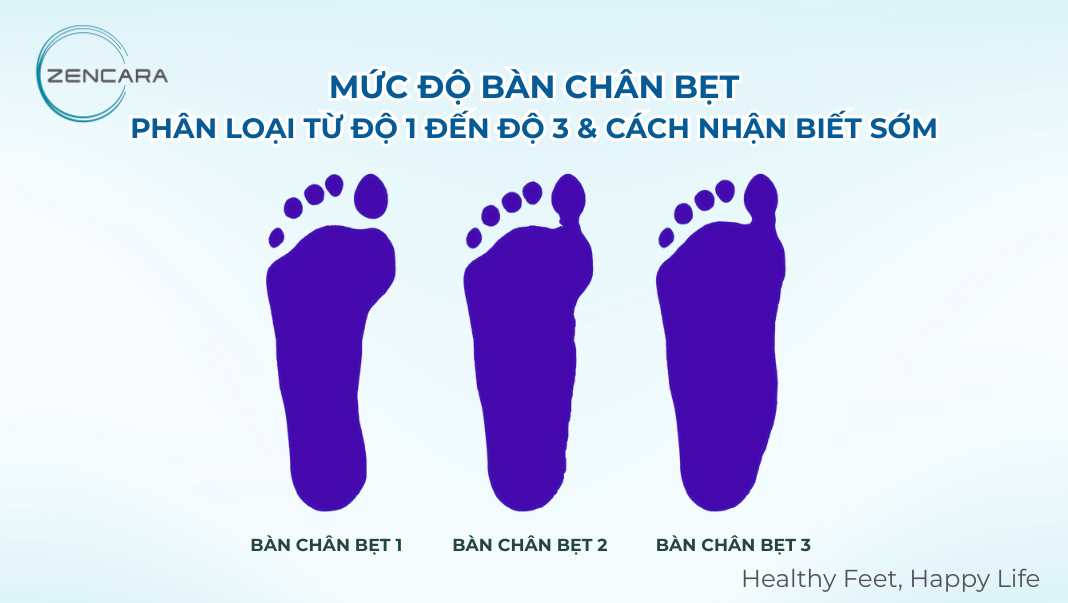 Mức độ bàn chân bẹt: Phân loại từ độ 1 đến độ 3 & cách nhận biết sớm