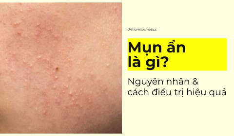 Mụn ẩn: Nguyên nhân và cách điều trị hiệu quả