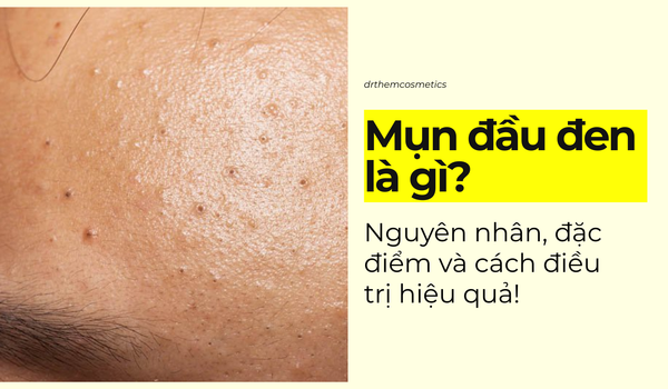 Mụn đầu đen là gì? Nguyên nhân, đặc điểm và cách điều trị hiệu quả