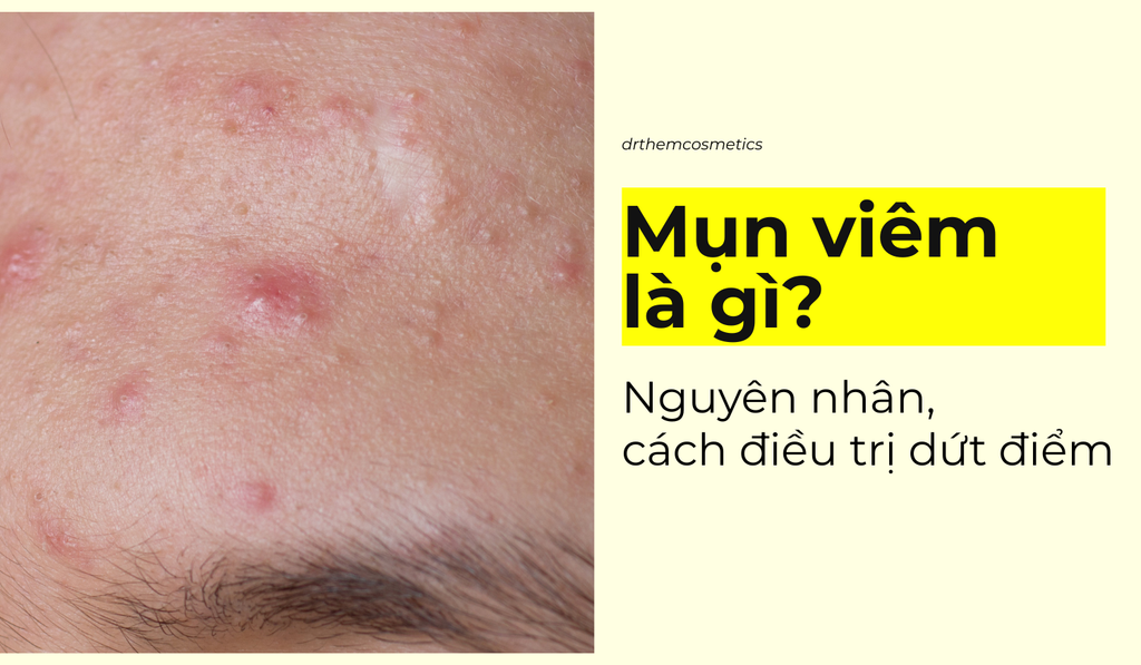 Mụn viêm là gì? Nguyên nhân, đặc điểm và cách điều trị hiệu quả