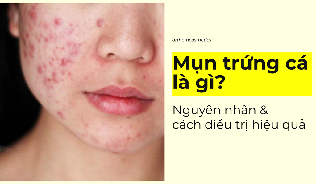 Mụn Trứng Cá: Hiểu Biết Toàn Diện, Nguyên Nhân, Hậu Quả và Cách Điều Trị Hiệu Quả