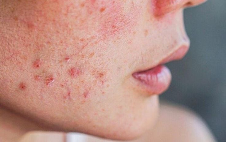 Da nhiễm corticosteroid: Phục hồi thế nào cho đúng?