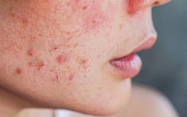 Da nhiễm corticosteroid: Phục hồi thế nào cho đúng?