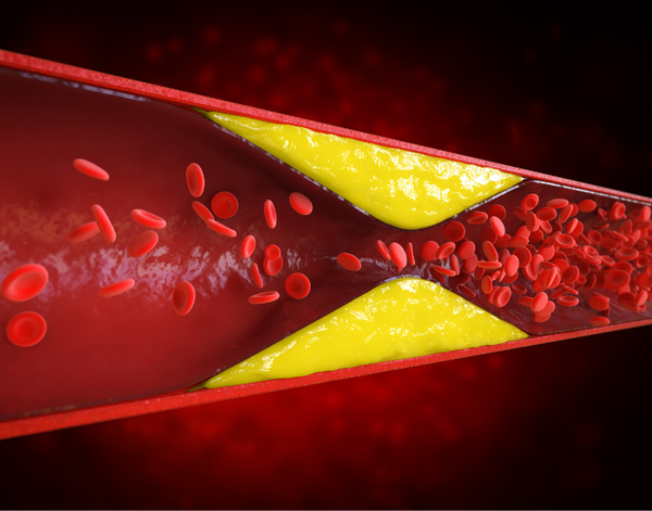 5 Biến Chứng Nguy Hiểm Do Mỡ Máu Cao