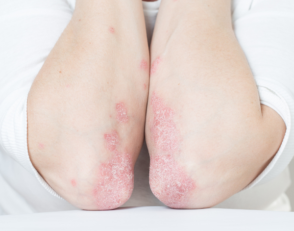 Bệnh Tự Miễn: Khi Hệ Miễn Dịch Quay Lại Tấn Công Cơ Thể - Hiểu Đúng Để Chữa Từ Gốc | Theo PGS.TS.BS Lê Xuân Hải