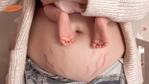 Ngừa rạn cho mẹ bầu nên bắt đầu từ đâu?