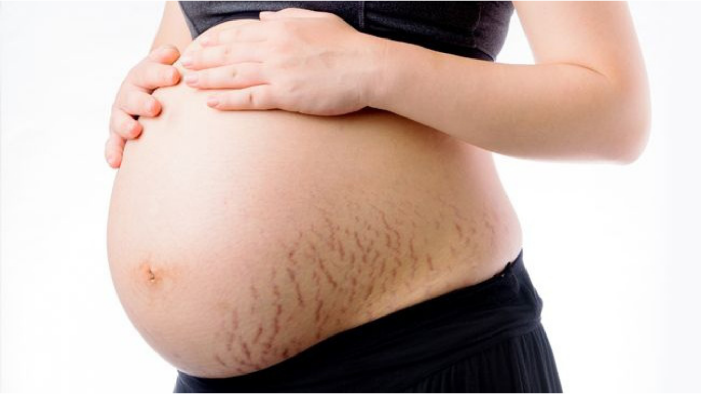 Thời Điểm Vàng Để Sử Dụng Sản Phẩm Ngừa Rạn Da
