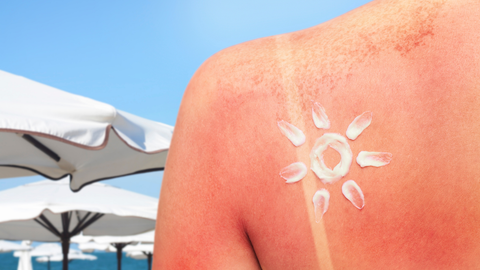 Da Cháy Nắng, Bong Tróc Sau Du Lịch: Nên Dùng Lotion Hay Oil Để Cứu Da Nhanh Hơn?