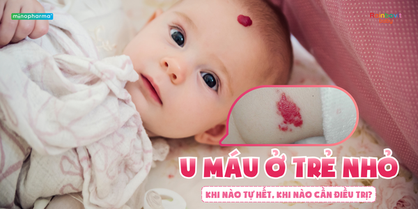 U máu ở trẻ nhỏ – Khi nào tự hết, khi nào cần điều trị?