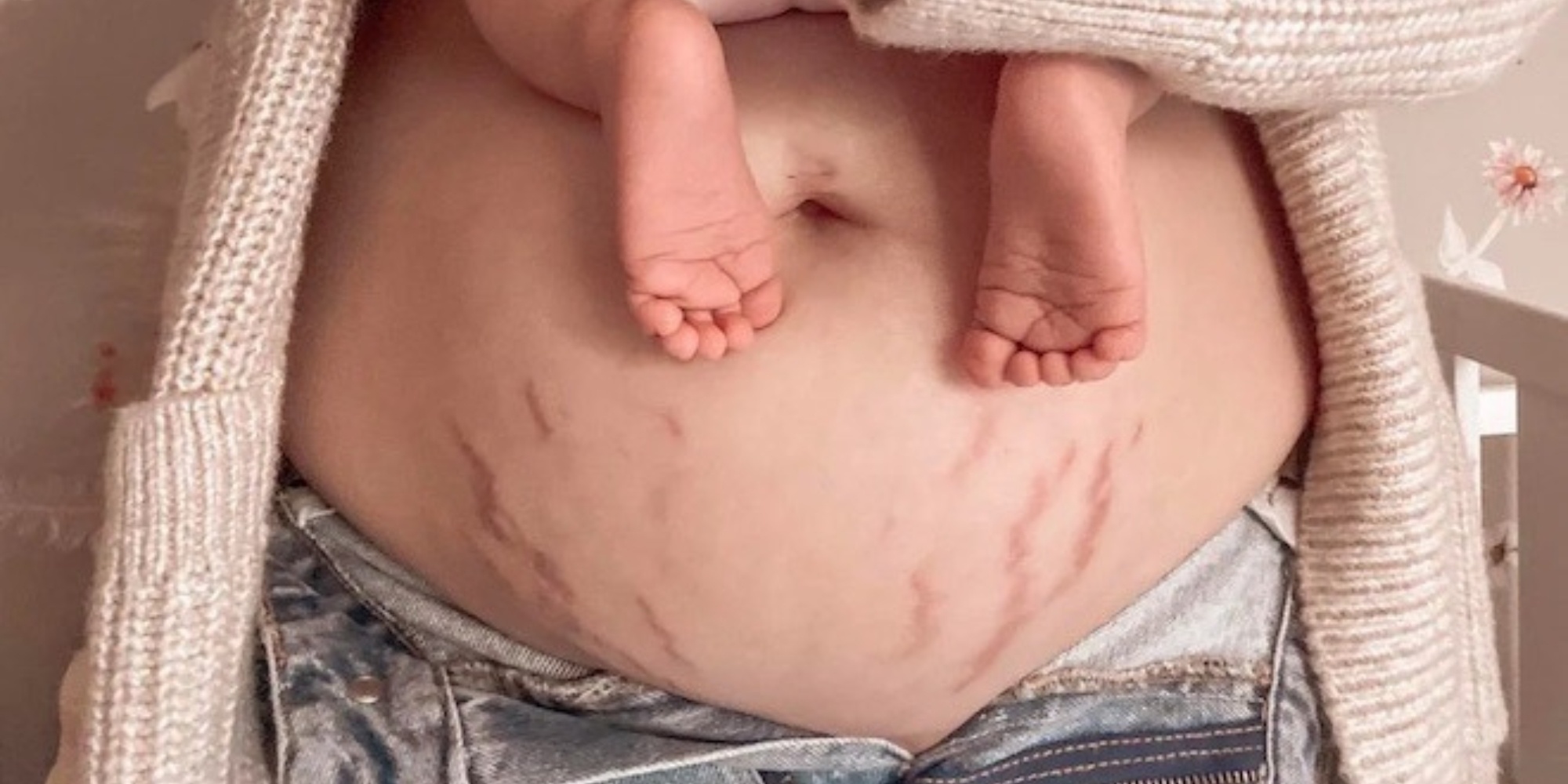 Cách Massage Làm Mờ Vết Rạn Da Sau Sinh