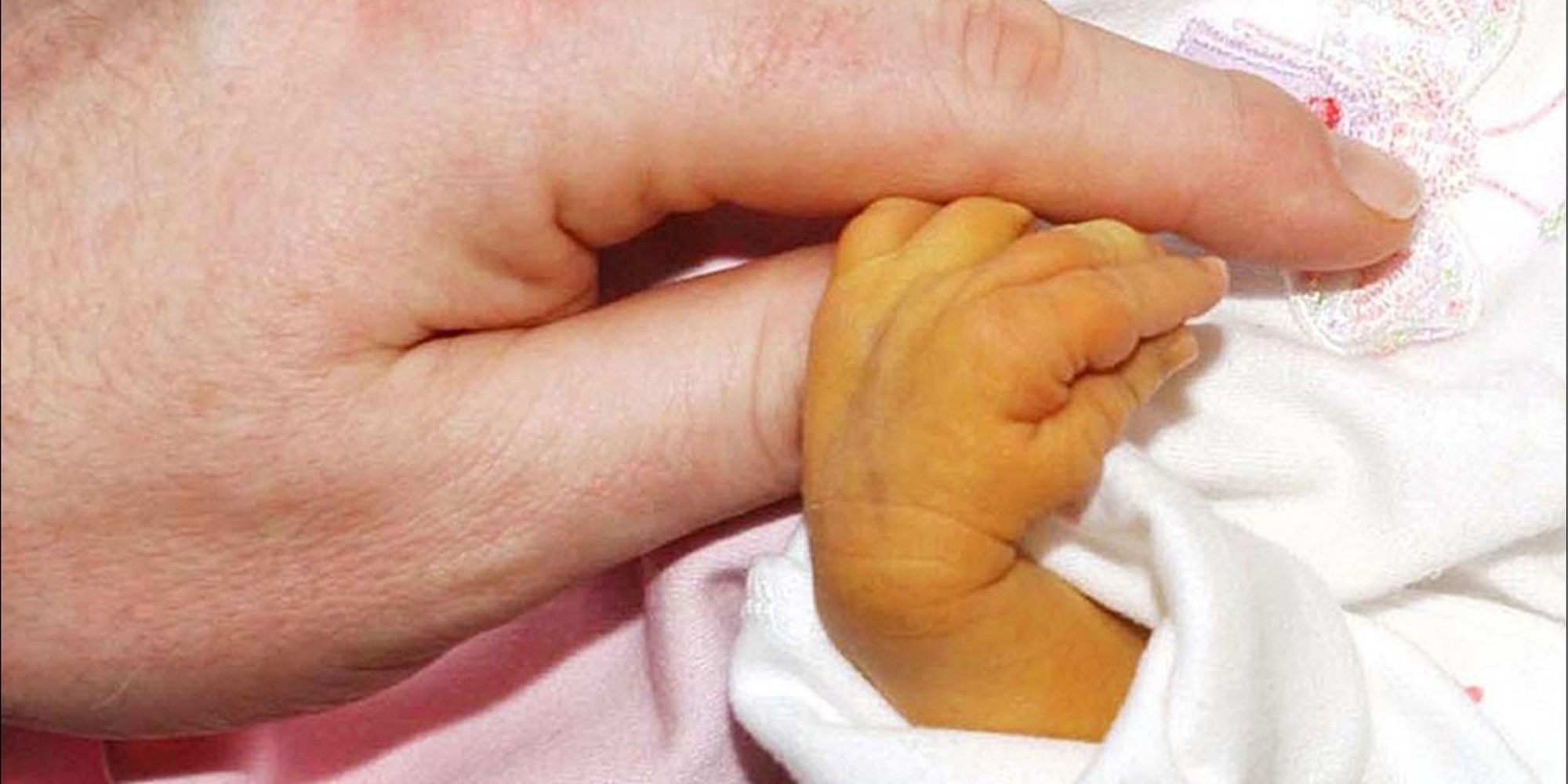 Cách Phân Biệt Vàng Da Sinh Lý Và Bệnh Lý Ở Trẻ Sơ Sinh