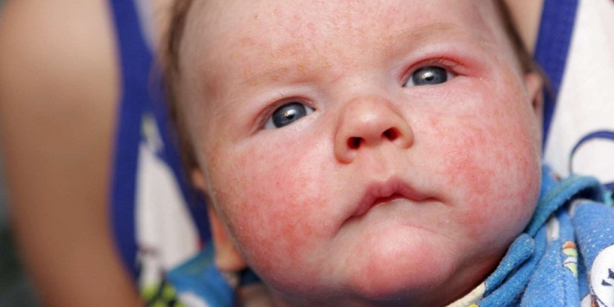 Cách Tìm Thực Phẩm Khiến Bé Dị Ứng Qua Sữa Mẹ Chính Xác Nhất