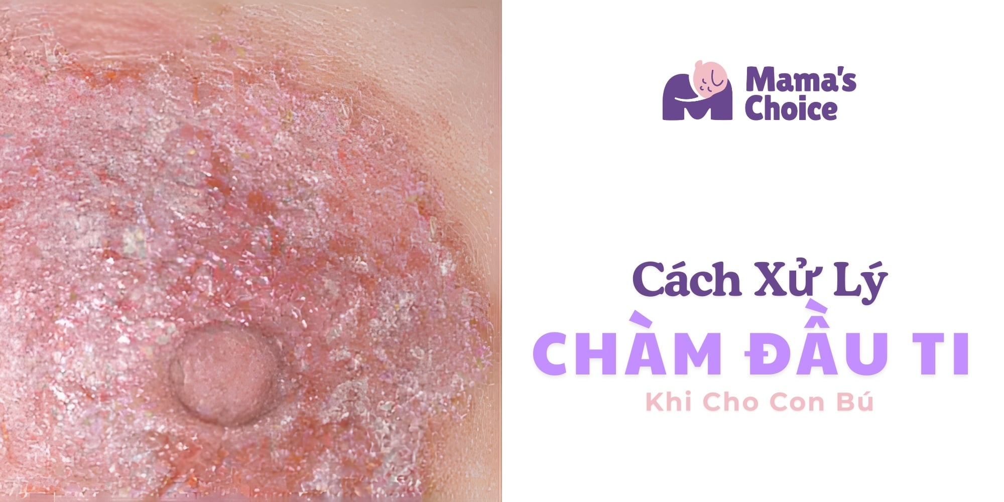 Cách Xử Lý Chàm Đầu Ti Khi Cho Con Bú