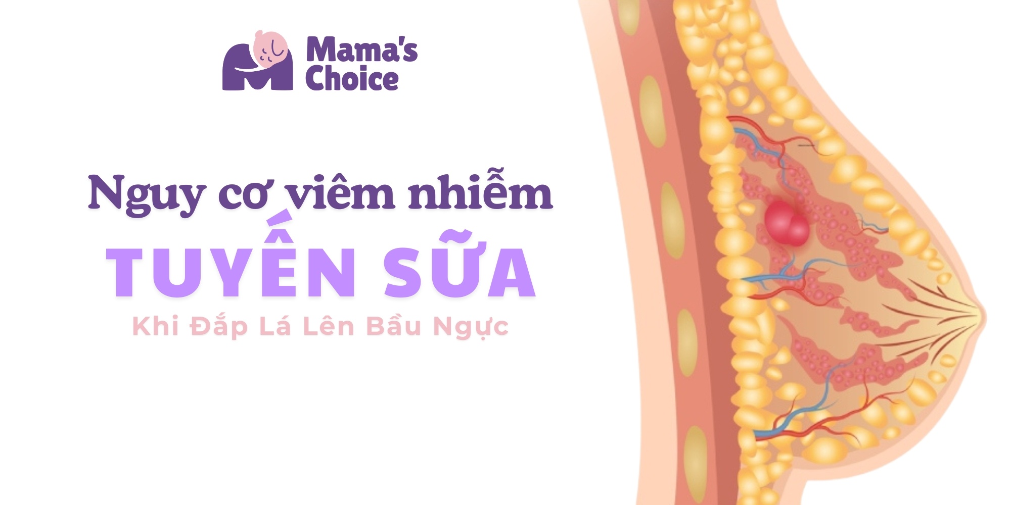 Nguy Cơ Viêm Nhiễm Tuyến Sữa Khi Đắp Lá Lên Bầu Ngực Gọi Sữa