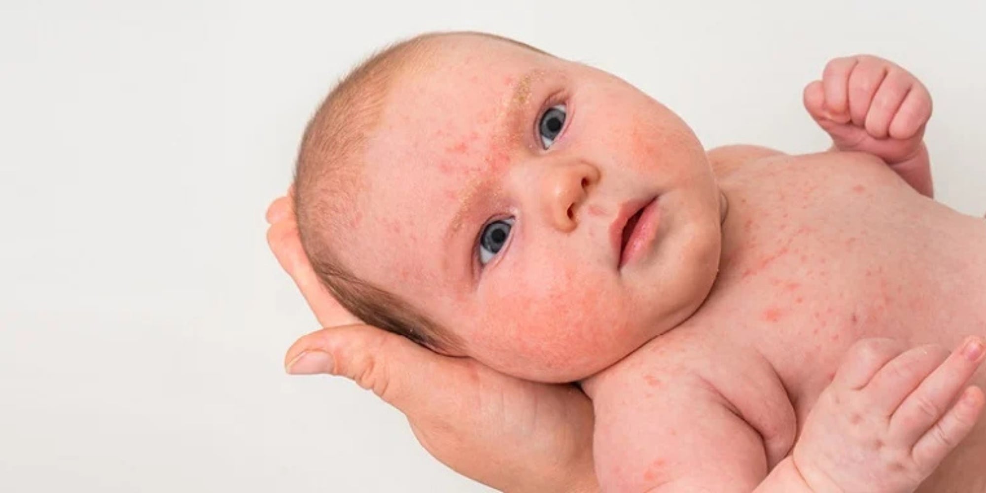 Cách Chăm Sóc Da Bé Bị Chàm Sữa & Rôm Sảy
