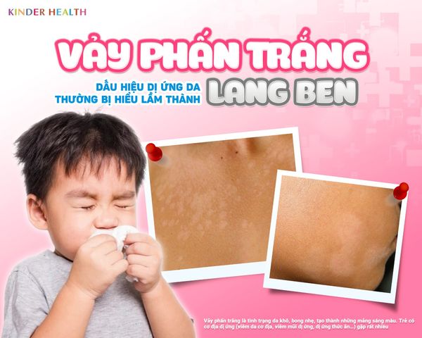VẢY PHẤN TRẮNG – DẤU HIỆU DỊ ỨNG DA THƯỜNG BỊ HIỂU LẦM THÀNH LANG BEN