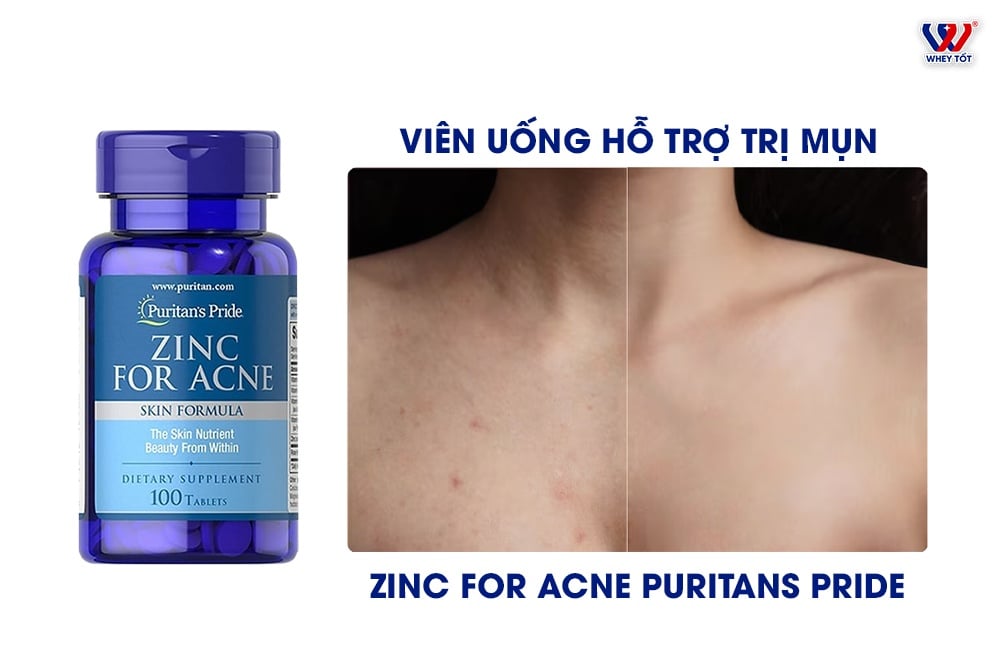 Viên Uống Trị Mụn Zinc For Acne Puritans Pride Có Tốt Không
