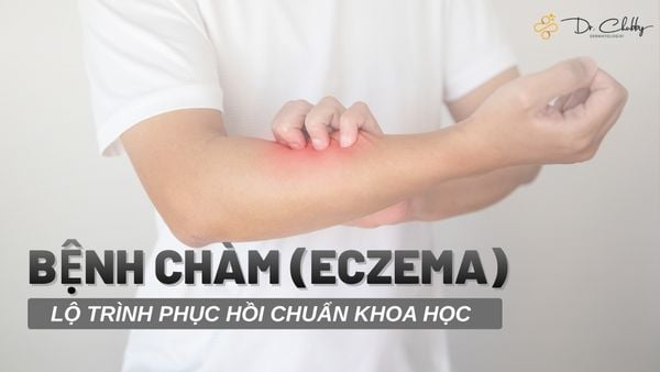 Eczema (Chàm): Lộ Trình Khoa Học Để Phục Hồi Hàng Rào Bảo Vệ Da