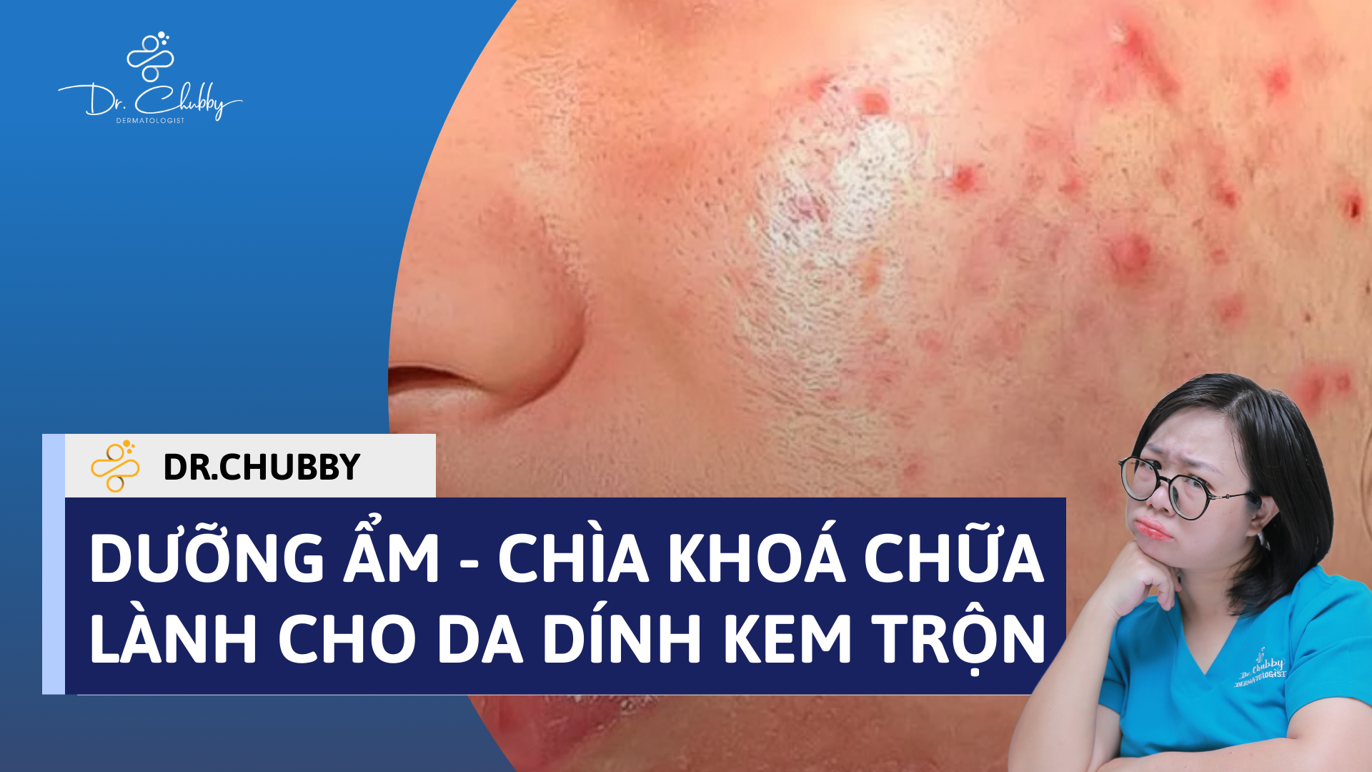 Da Bùng Mụn Khi Ngừng Kem Trộn: Hướng Dẫn Phục Hồi An Toàn