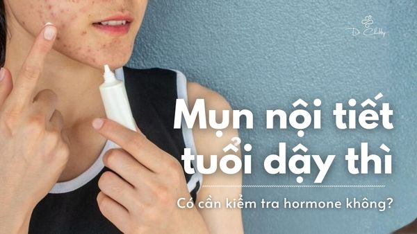 MỤN NỘI TIẾT TUỔI DẬY THÌ: CÓ CẦN KIỂM TRA HORMONE KHÔNG?