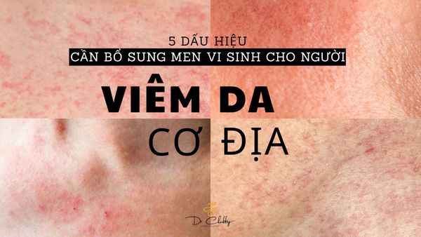 Viêm Da Cơ Địa Lâu Năm: 5 Dấu Hiệu Cho Thấy Bạn Cần Bổ Sung Men Vi Sinh
