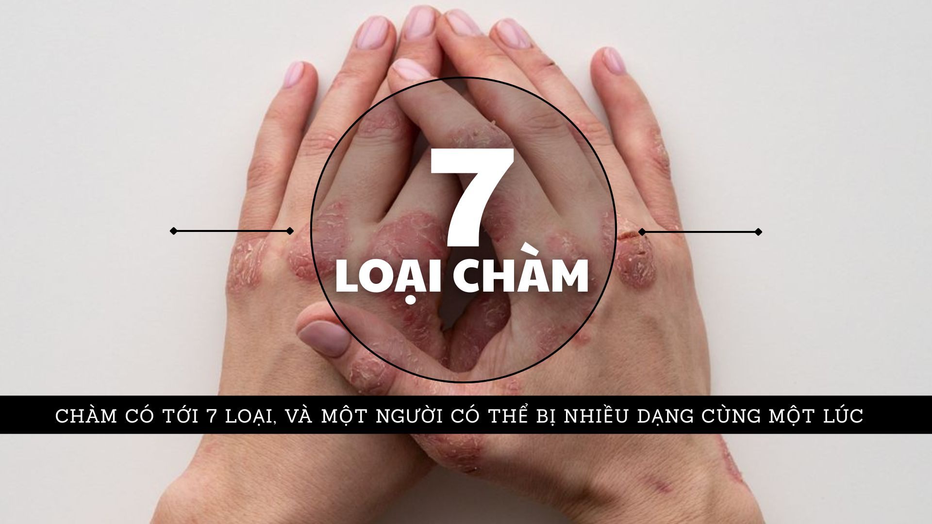 Chàm có tới 7 loại & một người có thể bị nhiều dạng cùng một lúc