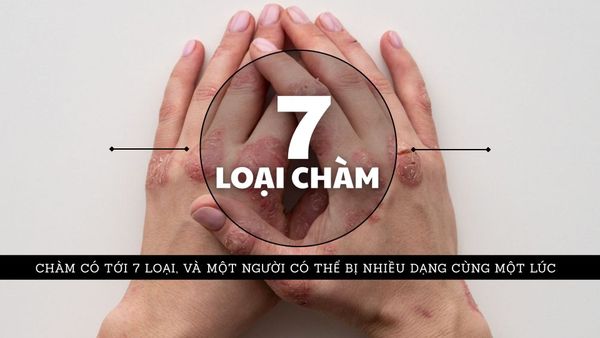 Chàm có tới 7 loại & một người có thể bị nhiều dạng cùng một lúc