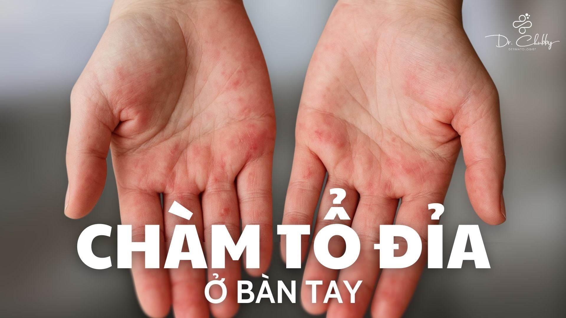 Chàm Tổ Đỉa: Tại Sao Chỉ Xuất Hiện Ở Lòng Bàn Tay Và Bàn Chân?