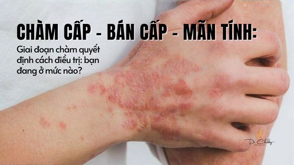 Chàm Cấp – Bán Cấp – Mãn Tính: Cách Nhận Biết Đúng Giai Đoạn