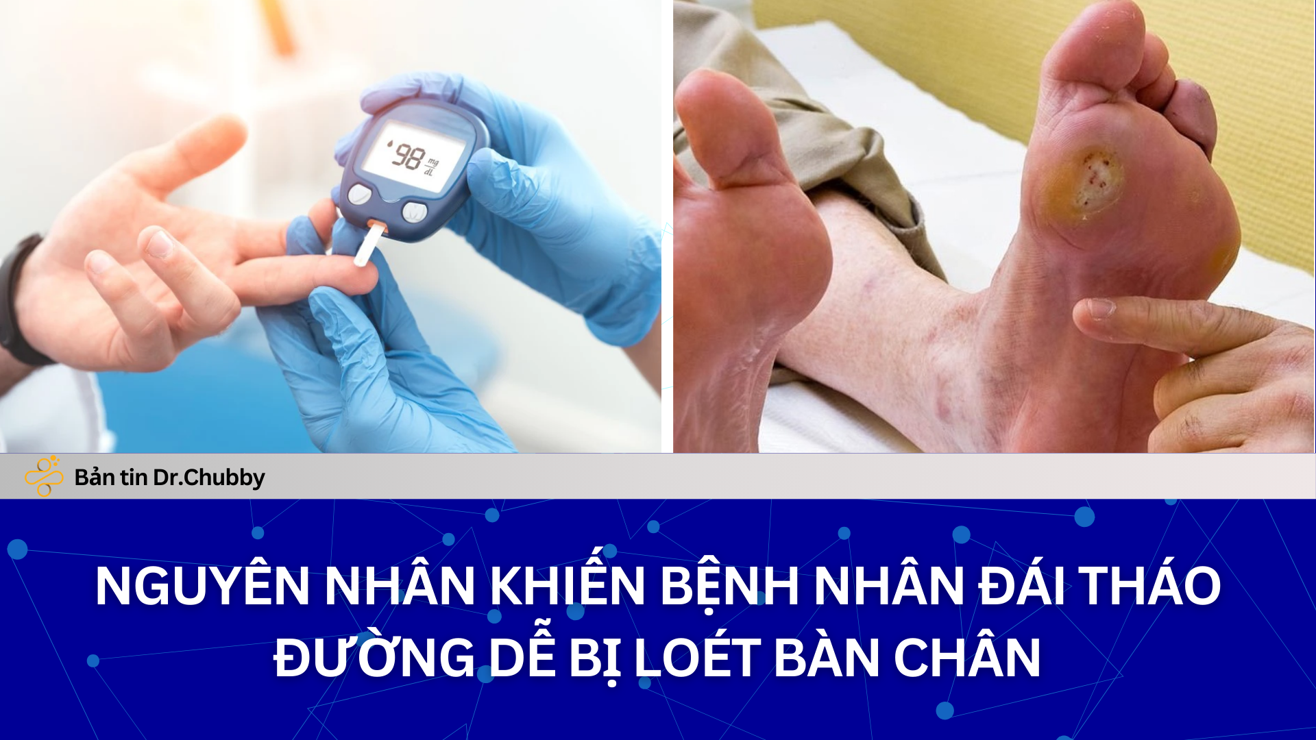Loét Bàn Chân Đái Tháo Đường: Hiểu Đúng Để Tránh Đoạn Chi