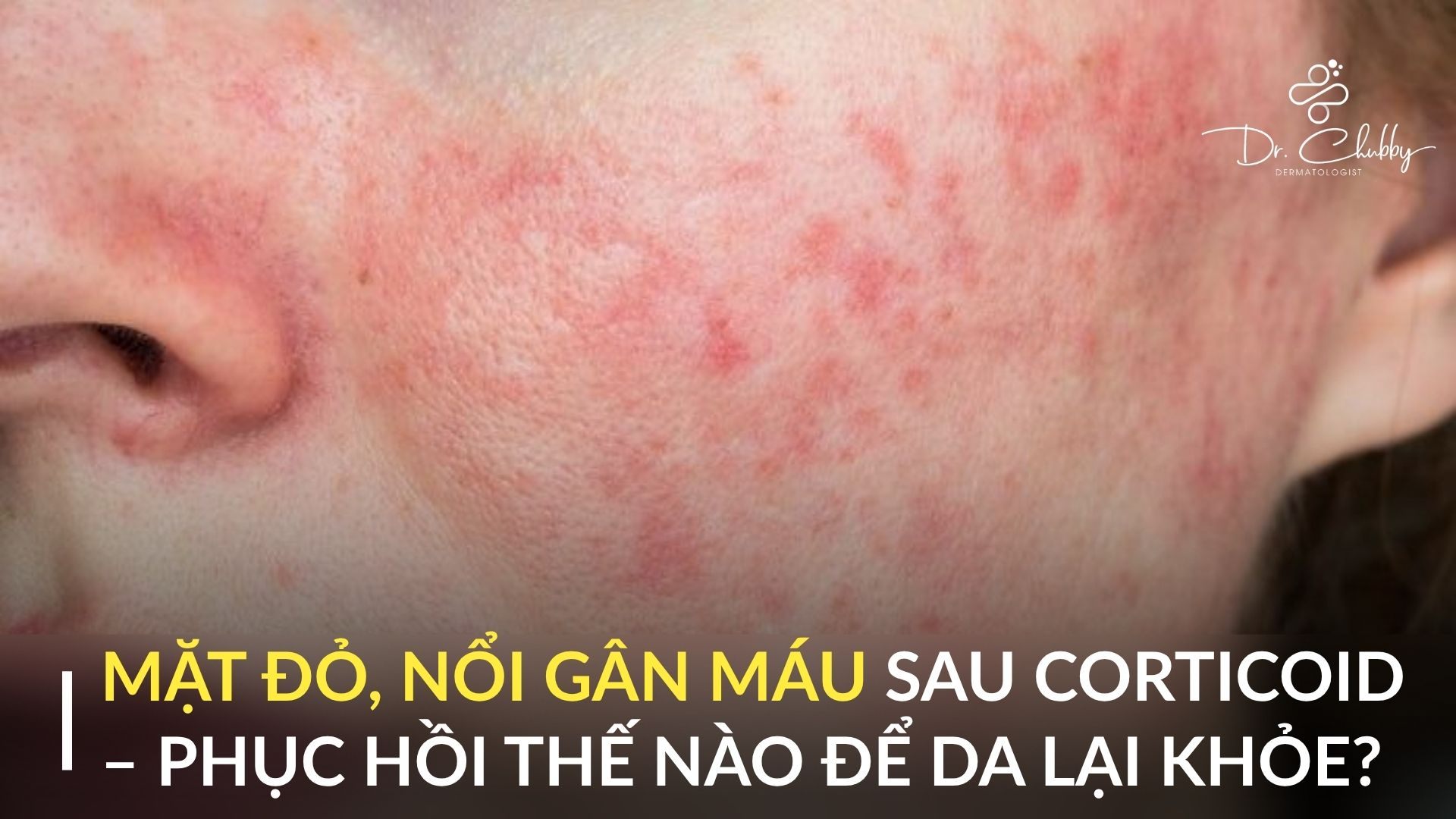 GIÃN MAO MẠCH DO CORTICOID: CƠ CHẾ TỔN THƯƠNG VÀ CHIẾN LƯỢC PHỤC HỒI HỆ VI TUẦN HOÀN