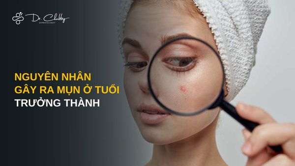 Mụn trưởng thành: Nguyên nhân và cách điều trị mụn cho tuổi 30+