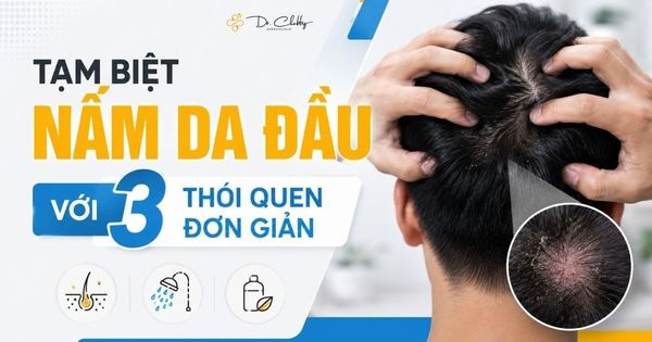 Lý Do Nấm Da Đầu Hay Tái Phát Và Cách Phòng Ngừa Từ Gốc