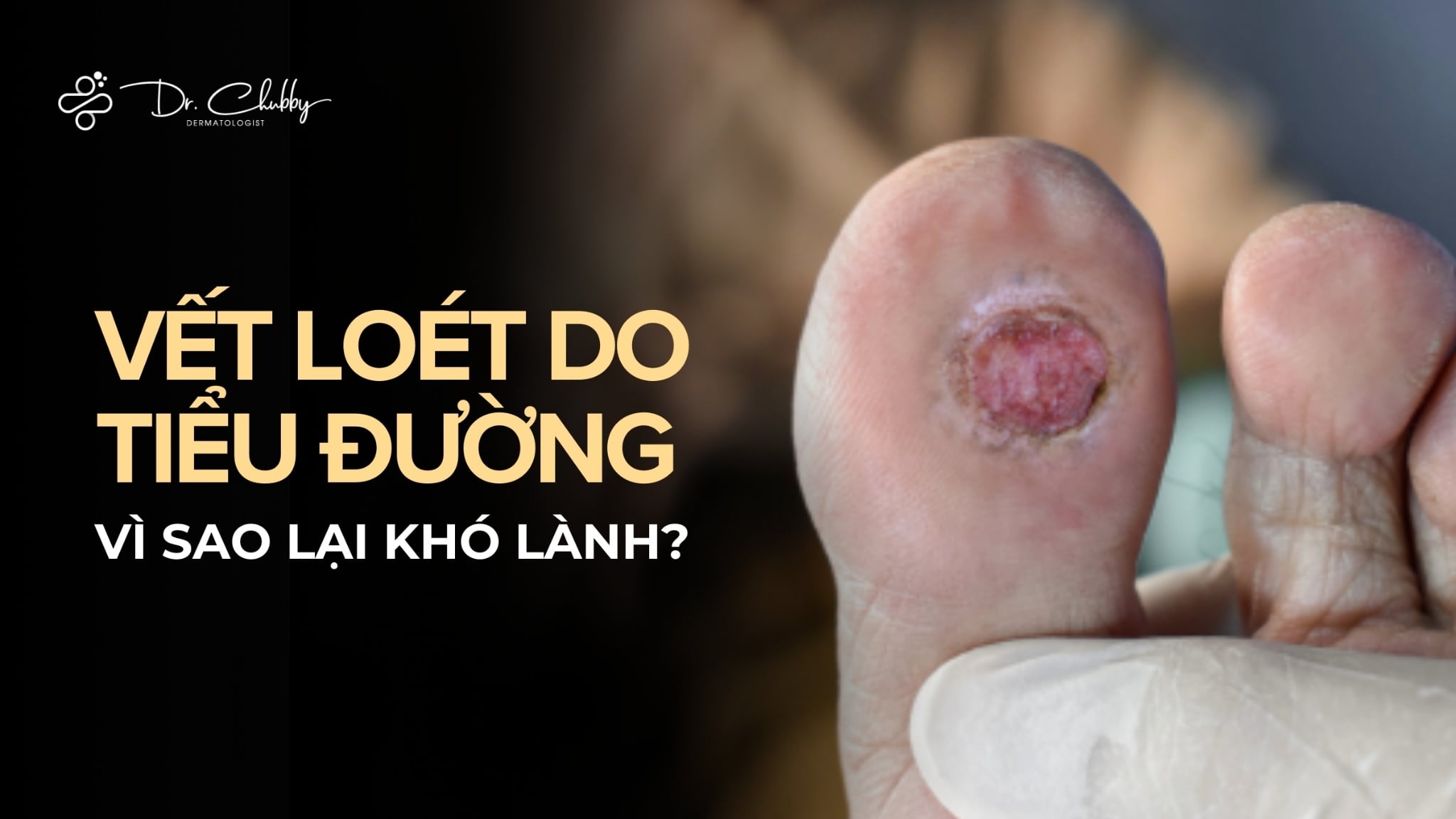 VẾT LOÉT DO TIỂU ĐƯỜNG VÌ SAO LẠI KHÓ LÀNH?