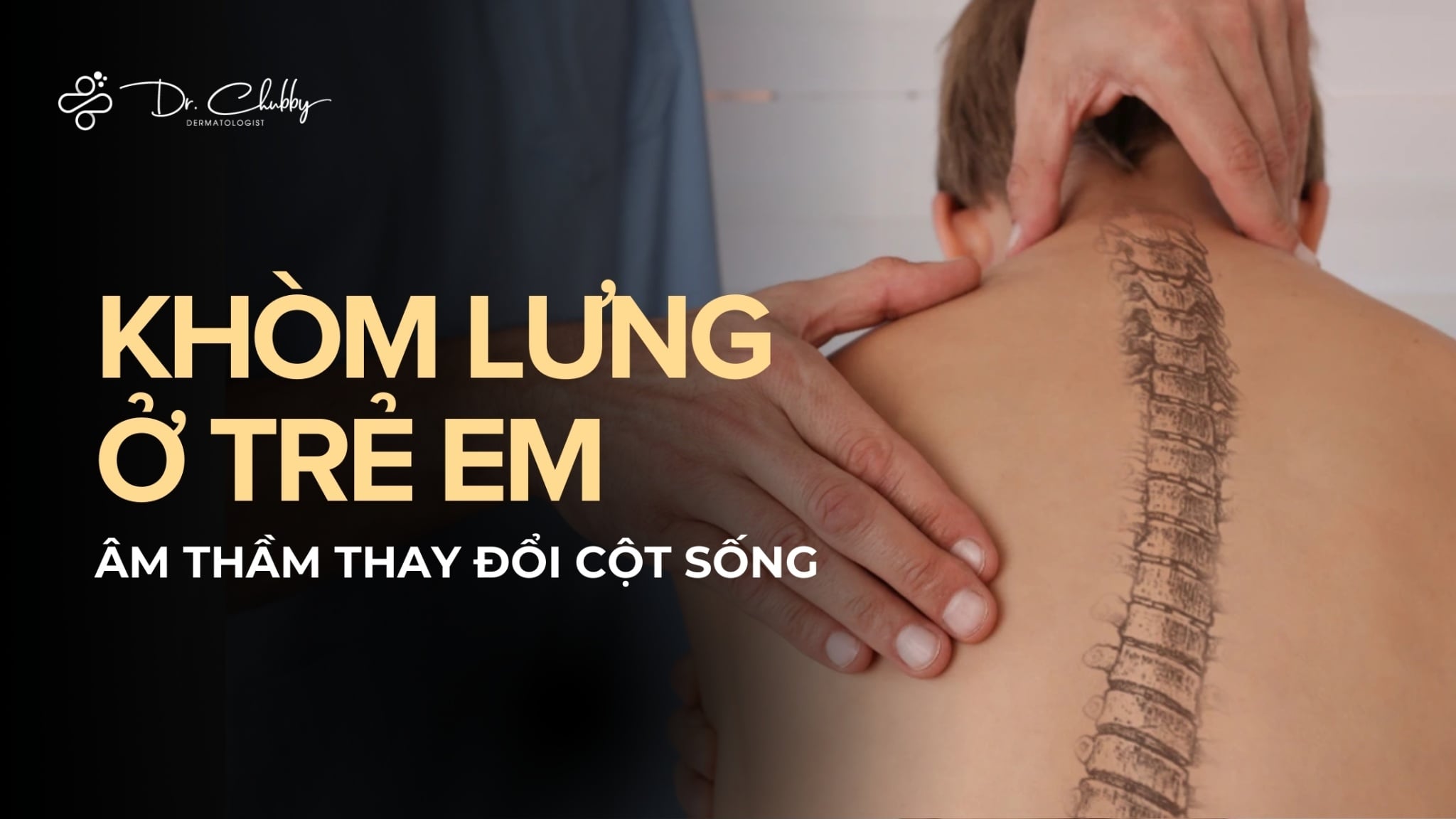 Khòm lưng ở trẻ em: Khi dáng ngồi của con đang “âm thầm” thay đổi cột sống