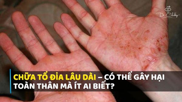 Cảnh báo tác dụng phụ khi trị tổ đỉa bằng corticoid mạnh