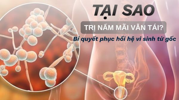 Trị Nấm Vùng Kín Bao Lâu Mới Hết Hẳn Và Không Tái Phát? Bí Quyết Từ Chuyên Gia Phụ Khoa
