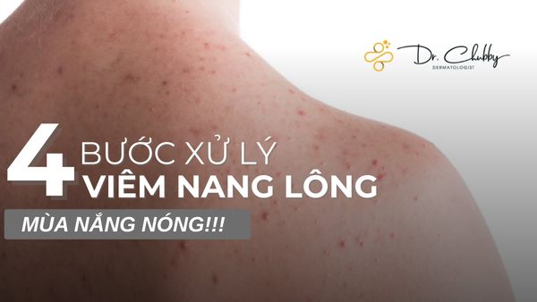 Dày Sừng Nang Lông (Keratosis Pilaris): Thấu Hiểu Cơ Chế Và Hướng Dẫn Chăm Sóc Khoa Học
