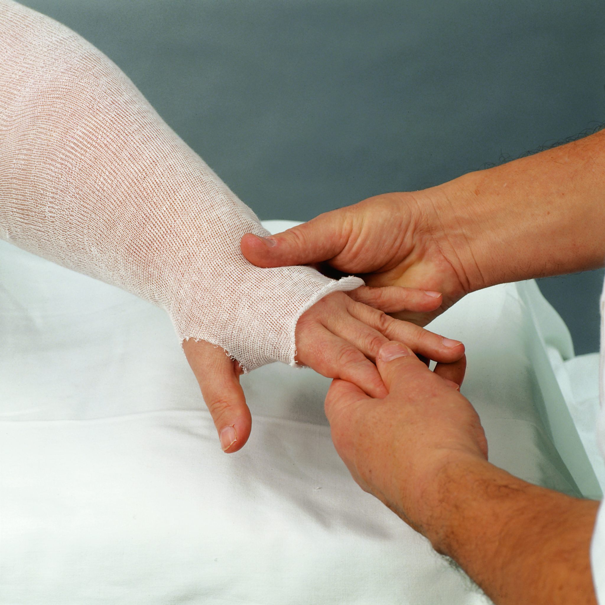Những dấu hiệu sớm của bệnh phù mạch bạch huyết là gì?