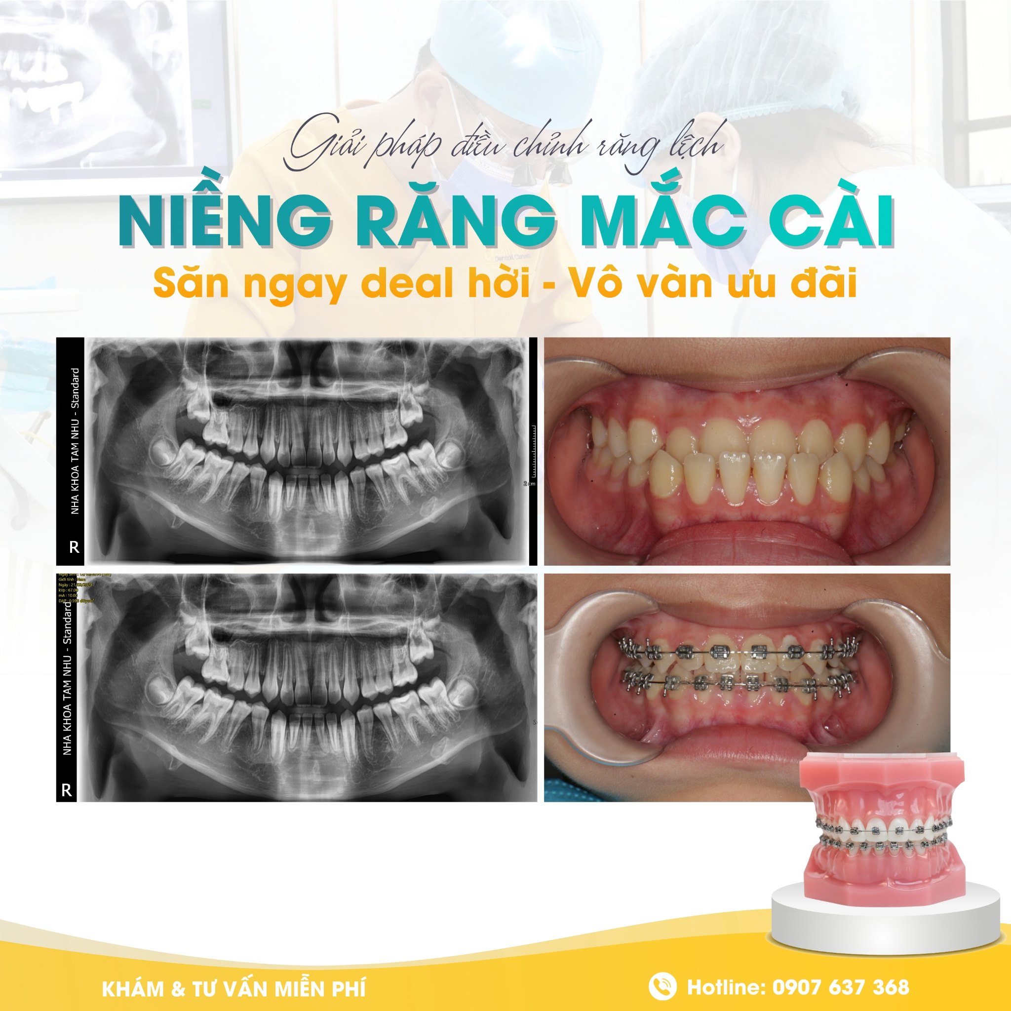 Chỉnh nha mắc cài – Giải pháp điều chỉnh răng lệch lạc hiệu quả tại Nha Khoa Tâm Như