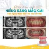 Chỉnh nha mắc cài – Giải pháp điều chỉnh răng lệch lạc hiệu quả tại Nha Khoa Tâm Như